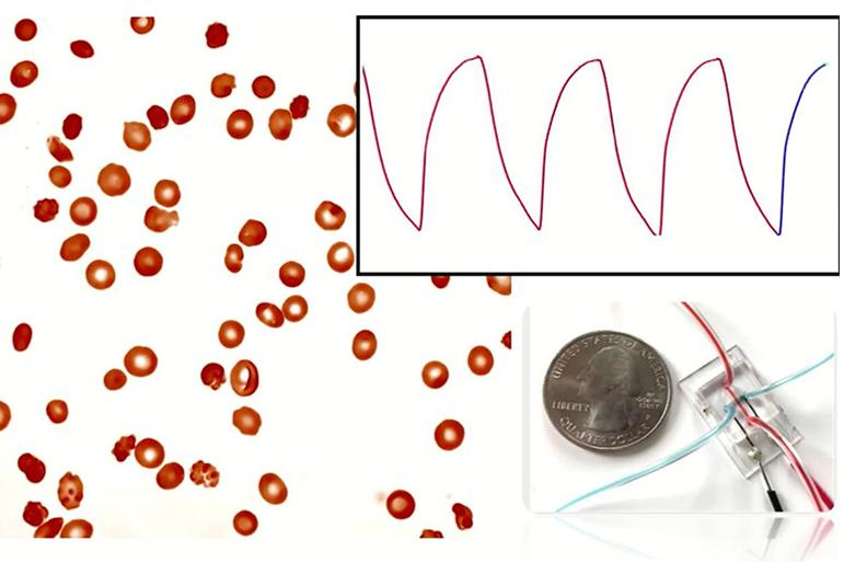 微流控阻抗傳感器可以監(jiān)測(cè)鐮狀細(xì)胞病 微流控阻抗傳感器可以監(jiān)測(cè)鐮狀細(xì)胞病