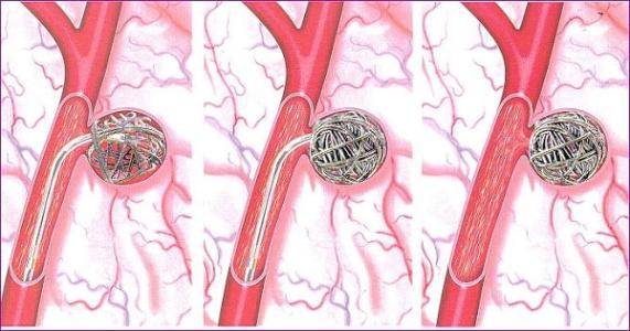 可拉伸的無(wú)線傳感器可以監(jiān)測(cè)腦動(dòng)脈瘤的愈合 可拉伸的無(wú)線傳感器可以監(jiān)測(cè)腦動(dòng)脈瘤的愈合